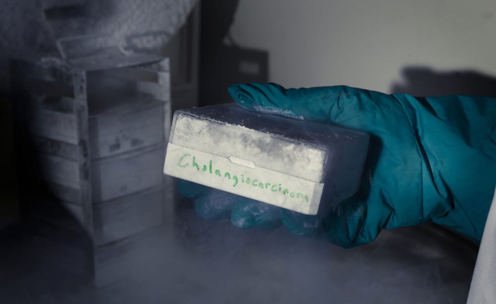 Cholangiocarcinoma Sample shown in research lab